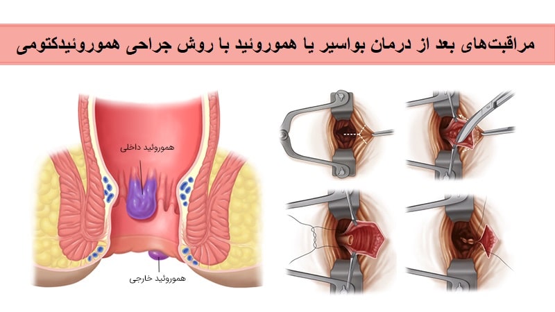 Hemorrhoidectomy.jpg