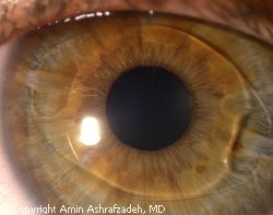 Verisyse%20by%20Dr%20Ash.jpg