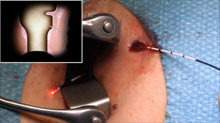Laser-fistula-treatment.jpg