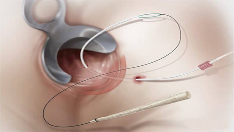 Treatment-of-fistula-with-surgery.jpg