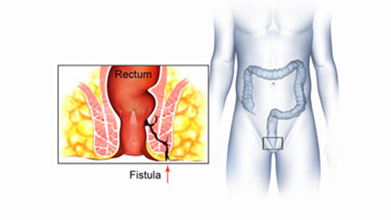 fistula4.jpg