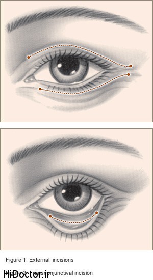 eyelid1.jpg