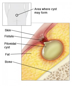 Hemorrhoid-laser-161019160340.jpg